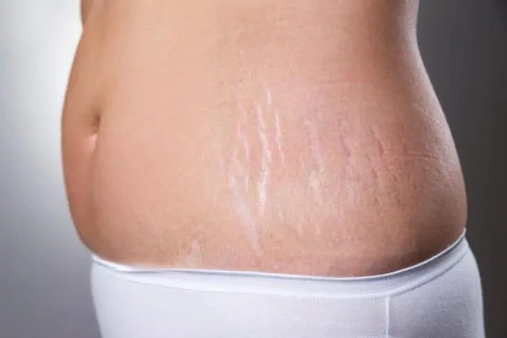 Cara Alami Menghilangkan Stretch Mark