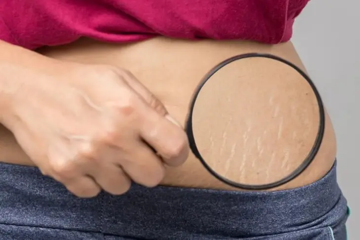 Cara Menghilangkan Stretch Mark Secara Alami