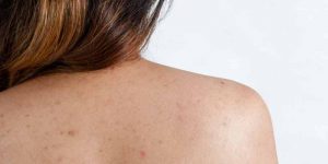 Cara Menghilangkan Jerawat Punggung