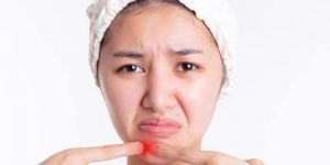 Penyebab Jerawat Dagu