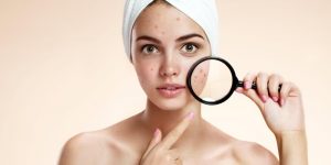 Penyebab Jerawat Pipi