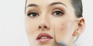 Cara Menghilangkan Bekas Jerawat