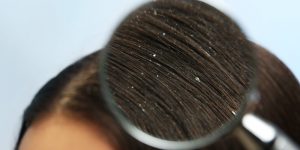 Cara Menghilangkan Ketombe