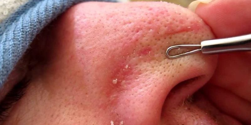 Komedo Putih (Whitehead)