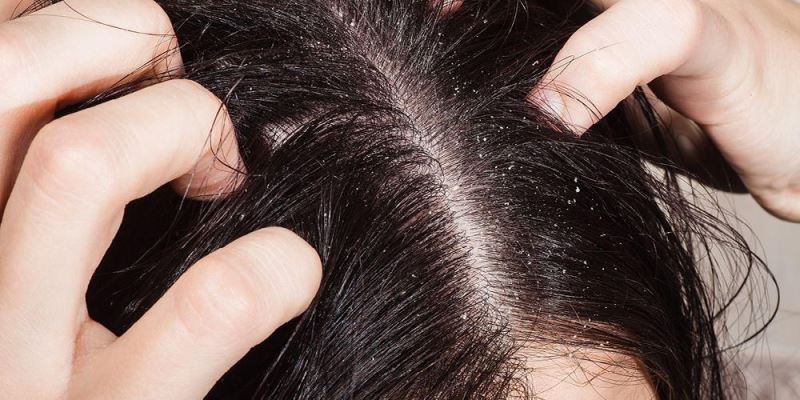 Kulit Kepala yang Kurang Sehat