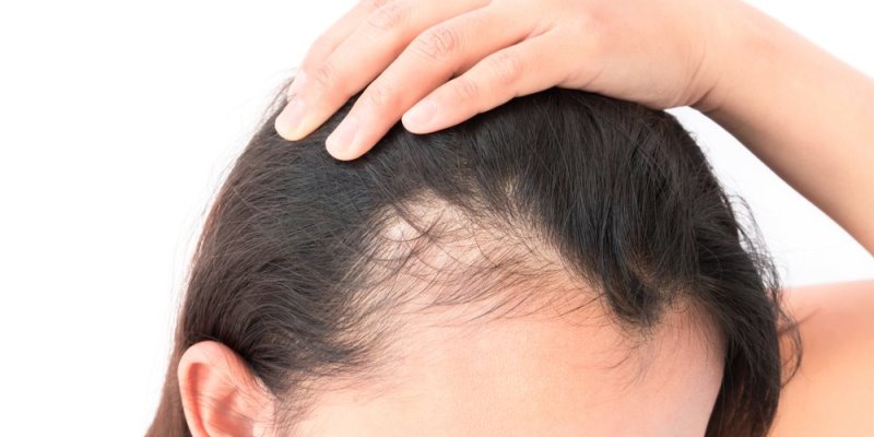 Rambut Rontok Bawaan