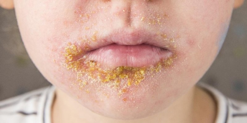 Impetigo