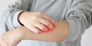 15 Cara Menghilangkan Kurap dengan Bahan Alami & Obat