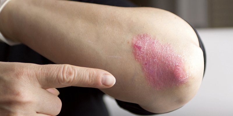 Psoriasis