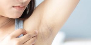 10 Cara Memutihkan Ketiak Hitam Secara Alami